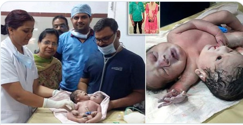 ولادة طفل برأسين و3 أذرع في حالة نادرة للغاية بالهند