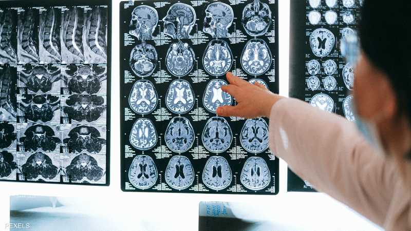 علماء: الإصابة بكورونا تؤثر على النصف الايسر من الدماغ