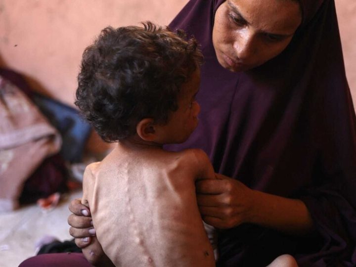 وباء جديد يضرب غزة: فيروس قاتل يشبه كورونا يفتك بالأطفال الجوعى