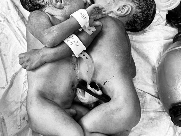 ولادة نادرة في مستشفى كركوك: توأم سيامي متلاصق في حالة مستقرة