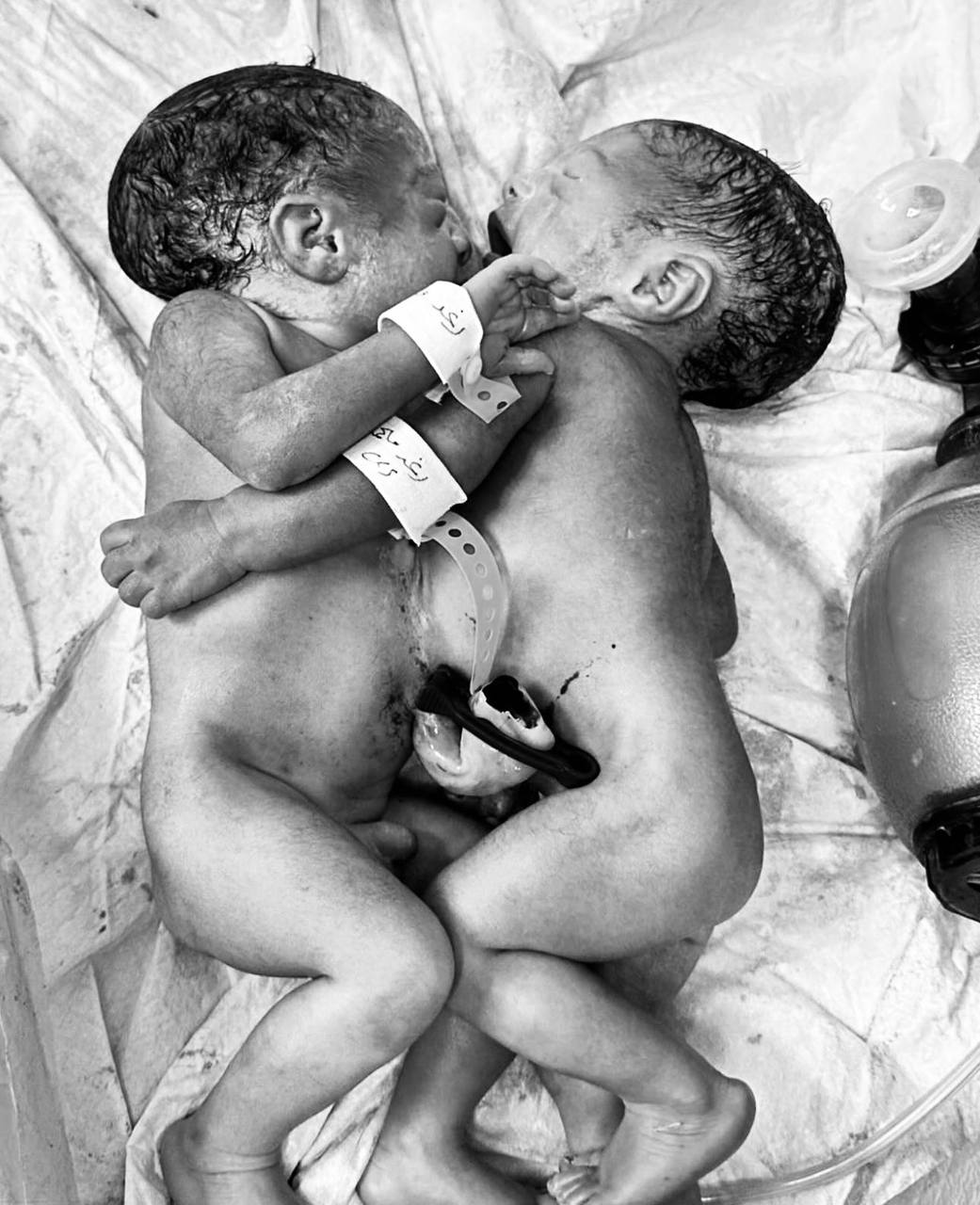 ولادة نادرة في مستشفى كركوك: توأم سيامي متلاصق في حالة مستقرة